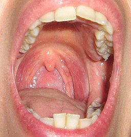 What are the Symptoms of Tonsil Infections